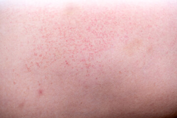 Fototapeta premium Close up of irritated human skin with red rash and inflammation, suitable for medical, dermatology, allergy, and skincare-related concepts in healthcare or pharmaceutical design.