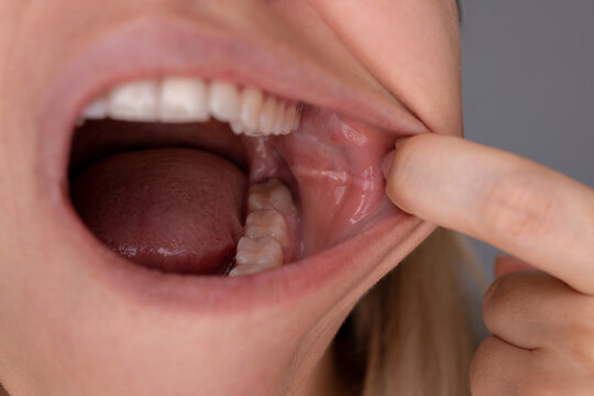 Close-up of a young woman revealing bite marks on the inside of her cheek, caused by stress and misalignment. A raw and intimate portrayal of hidden discomfort