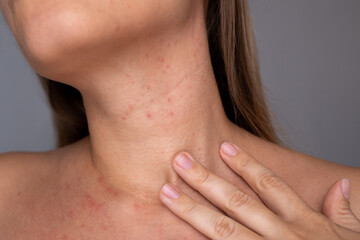 Close-up of a young woman’s neck and chest showing visible skin irritation and small red bumps. A...