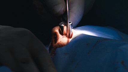 Surgical procedure focusing on septoplasty and rhinoplasty, showcasing a close-up of hands using...
