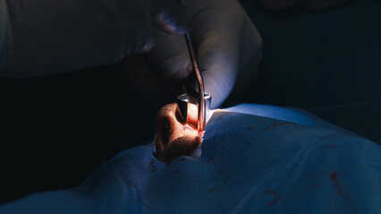 Surgical procedure for septoplasty and rhinoplasty, showcasing a close-up of a surgeon's hand using...