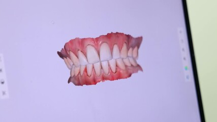 Digital 3D scan of upper and lower dental arches displayed on a computer during dental procedure