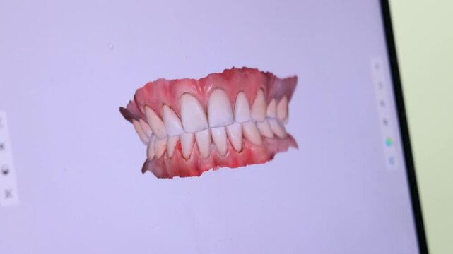 Digital 3D scan of upper and lower dental arches displayed on a computer during dental procedure