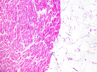 Left ventricular hypertrophy is seen in diseases such as hypertension. Histopathological changes include myocardial hypertrophy, disordered arrangement and fibrous hyperplasia.Magnify 100x.
