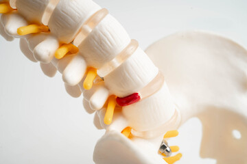 Spinal nerve and bone, Lumbar spine displaced herniated disc fragment, Model for treatment medical...