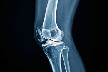 X-ray image of a human knee joint, showcasing bone structure and ligaments