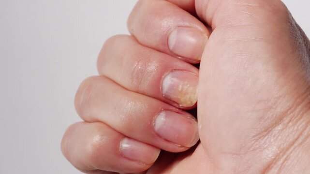 Psoriasis at the nail. Psoriasis is an autoimmune disease that affects the skin and nails. Close up. High quality photo