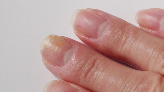 Psoriasis at the nail. Psoriasis is an autoimmune disease that affects the skin and nails. Close up. High quality photo