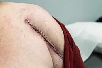 Fototapeta premium Post-Surgery Shoulder with Surgical Staples and Healing Incision