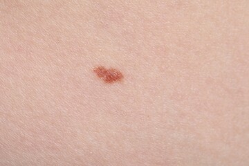 Woman with mole on her skin, macro view
