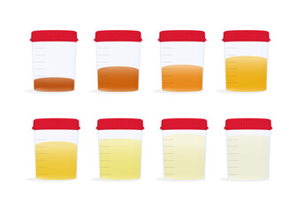 Urine samples with different coloured stock illustrations