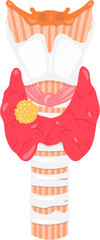 Thyroid nodule
