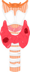 Thyroid cancer 