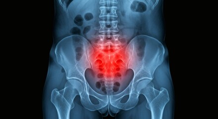 Lumbar Pain XRay View of Inflammation in Lower Back Area on Black.