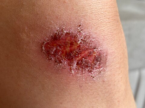 Close-Up of Skin Lesion on Human Knee – Medical Reference Photo