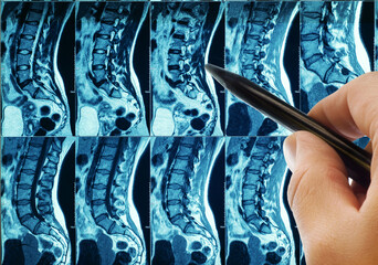 CT of the spine and the doctor's hand. Medicine, science and MRI of the spine. Magnetic resonance imaging. The doctor takes a picture of the spine.