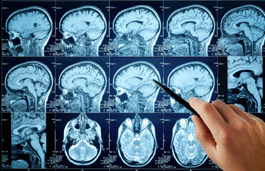 CT scan with brain and doctor's hand. Medical, science and mri brain background. Magnetic resonance imaging. The doctor is doing a brain. Closeup of a CT scan with brain. Magnetic resonance imaging. 