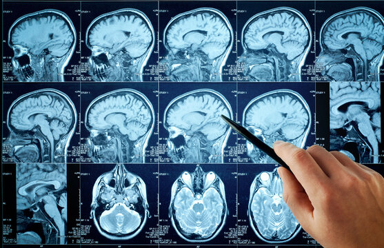 CT scan with brain and doctor's hand. Medical, science and mri brain background. Magnetic resonance imaging. The doctor is doing a brain. Closeup of a CT scan with brain. Magnetic resonance imaging. 