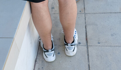 Foot with blister or chafing caused by uncomfortable shoes, showing skin irritation, footwear...