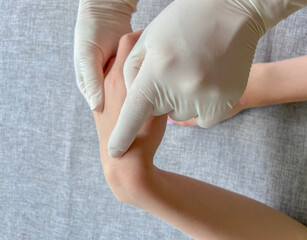 Visible bump under skin suggests ganglion cyst on woman&#x27;s arm. Female hand turned downward, showing joint abnormality and wrist hygroma. Swollen joint on wrist under skin, hand or joint pathology.