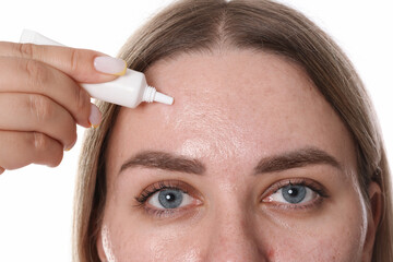 Woman applying cream onto face on white background, closeup. Acne treatment
