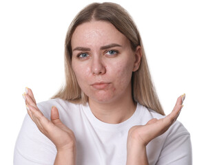 Woman with acne problem on white background