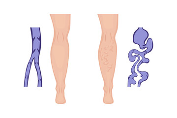 Comparing healthy leg veins with varicose veins and their internal structure