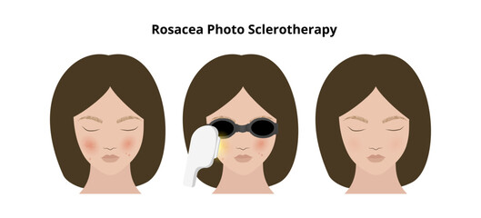 Woman undergoing rosacea photosclerotherapy treatment for facial redness