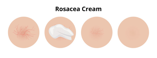 Cream treating rosacea, before and after effect
