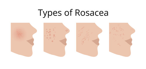 Four types of rosacea showing different symptoms on face skin