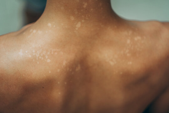 Close-up view of a bare back with multiple light skin patches around the shoulders and upper back area. Dermatological condition clearly visible. Skin condition, dermatology and medical observation.