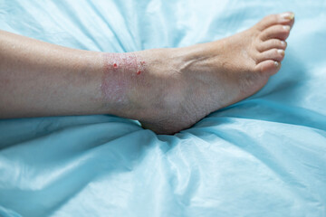 psoriatic rashes on skin with chronic dermatitis, wound on painful female leg, chronic condition, dermatological disorder, skin problem, affected area