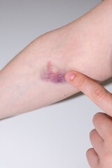 bruise on female hand skin, hematoma on elbow area from blood draw, hurt mark, medical treatment,...