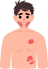 Fototapeta premium Herpes zoster 