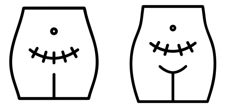 female body with cesarean section scar. medical postpartum recovery, childbirth surgery, maternal strength, women's health, body-positive representation in obstetrics, gynecology