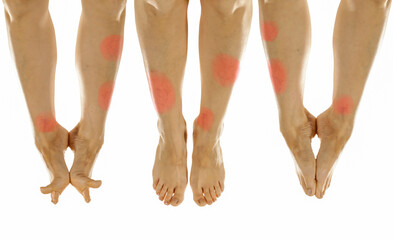 Sore legs with red pain points isolated on white – medical and therapeutic concept. Joint pain,...