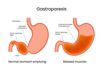 Gastroparesis Normal Stomach Emptying vs. Relaxed Muscles
