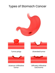 Types of the Stomach Cancer