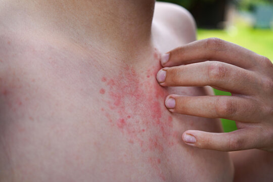 A boy rubs his hand over skin rashes resulting from allergies or hives. Skin conditions, dermatology.