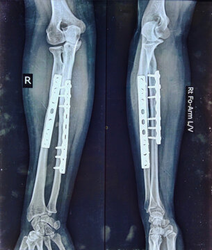 Post operative x-ray of radius and ulna fracture showing fixation by plate and screw. X ray image of forearm fracture after internal fixation. Plate and screw fixation for radius ulna fracture.