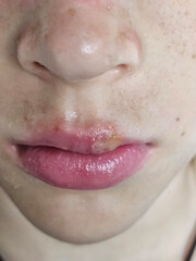 Herpesvirus infections in children. Herpes in a child is essentially a chronic recurrent infection...