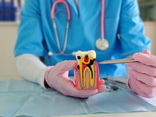 Dentist demonstrating root canal procedure on a model tooth