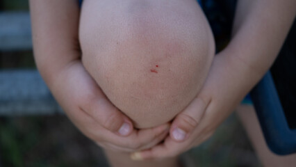 Close-up of child s scraped knee with small cut outdoors