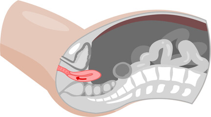 Uterine prolapse 