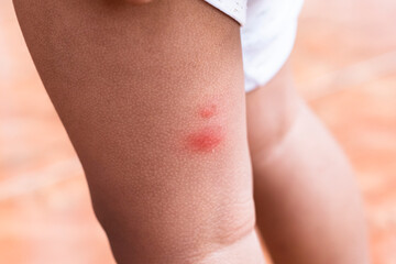 Mosquito bites on toddler's legs. Bumps on skin caused by mosquito bites. Red skin caused by mosquito bites while toddler is sleeping.