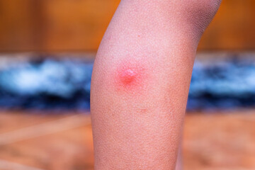 Mosquito bites on toddler's legs. Bumps on skin caused by mosquito bites. Red skin caused by mosquito bites while toddler is sleeping.