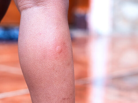 Mosquito bites on toddler's legs. Bumps on skin caused by mosquito bites. Red skin caused by mosquito bites while toddler is sleeping.