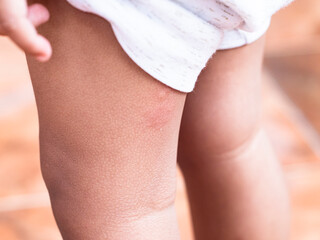 Mosquito bites on toddler's legs. Bumps on skin caused by mosquito bites. Red skin caused by mosquito bites while toddler is sleeping.