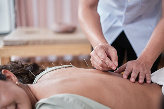 Close-up shot of Asian physiotherapist's hand, acupuncture treatment to Latin woman patient, healing muscle and back pain relief, passive medical therapy at healthcare wellness spa in hospital clinic.