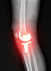 Anterior and lateral views of artificial knee joints post-surgery, visualized in radiant contrast to evaluate implant positioning.